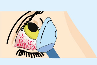 scleral dry.jpg